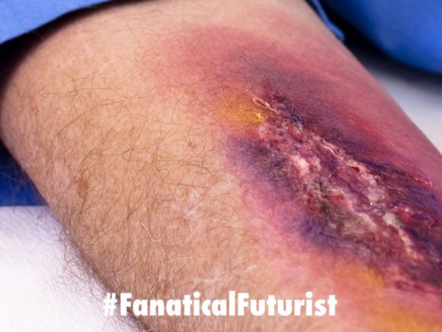 futurist_third_degree_burn