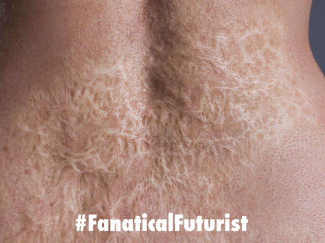 futurist_skin_burns